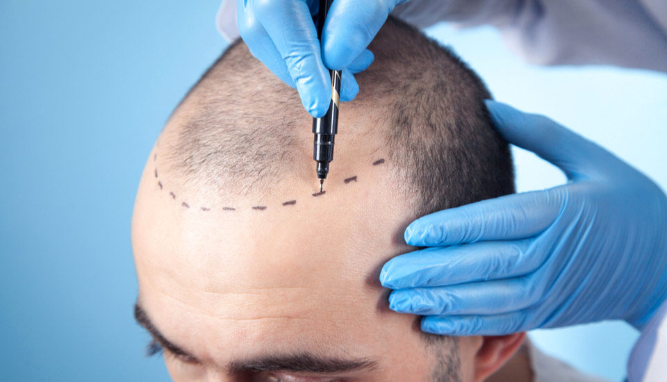 Exploring the Impact of Hair Dye on Hair Restoration Procedures
