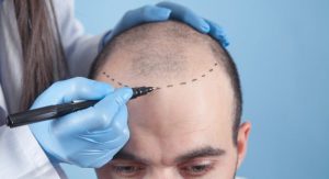 Hair Transplant