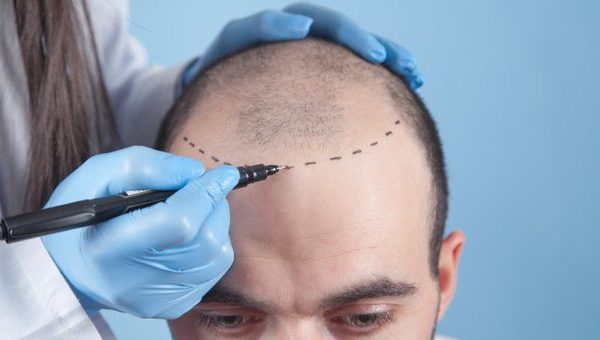 Hair Transplant