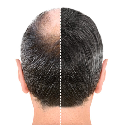 Hair Transplant Before after
