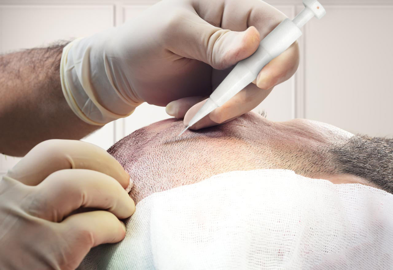 DHI Hair Transplant: The Modern Way to Get Natural-Looking Hair
