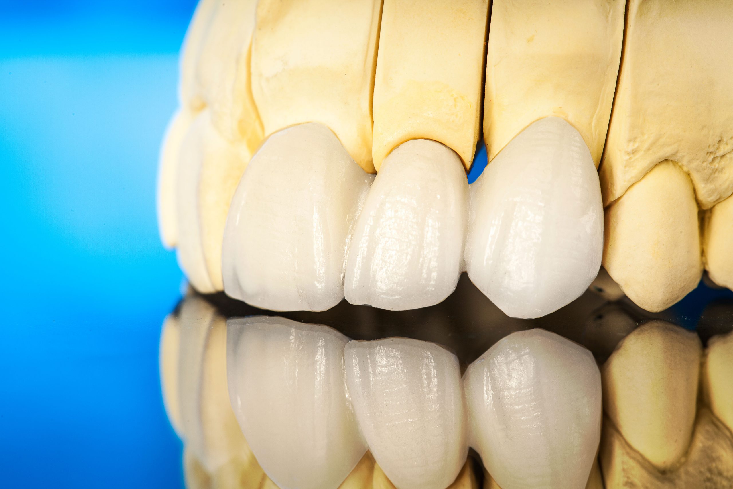 Dental Crowns: Really Protect Teeth from Decay and Gum Disease