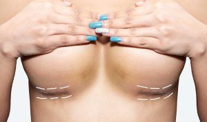 Breast Uplift