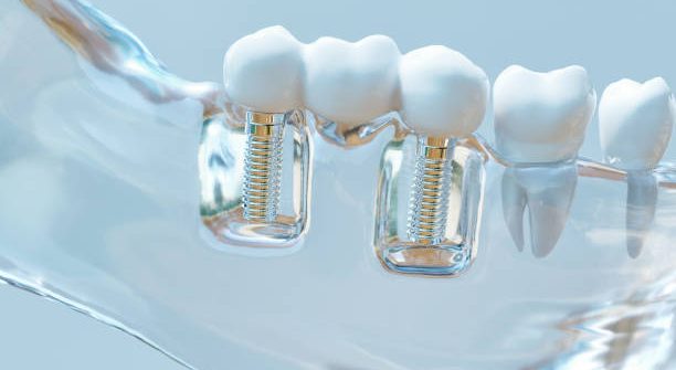 Tooth human implant -- 3D Rendering