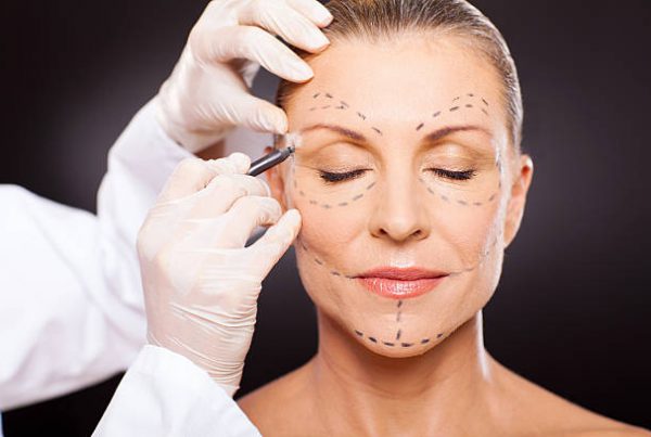 Facelift