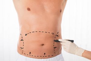 Tummy Tuck