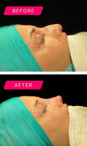 nose job before after photos - 2
