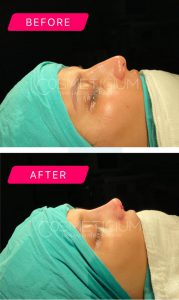 nose job before after photos - 1