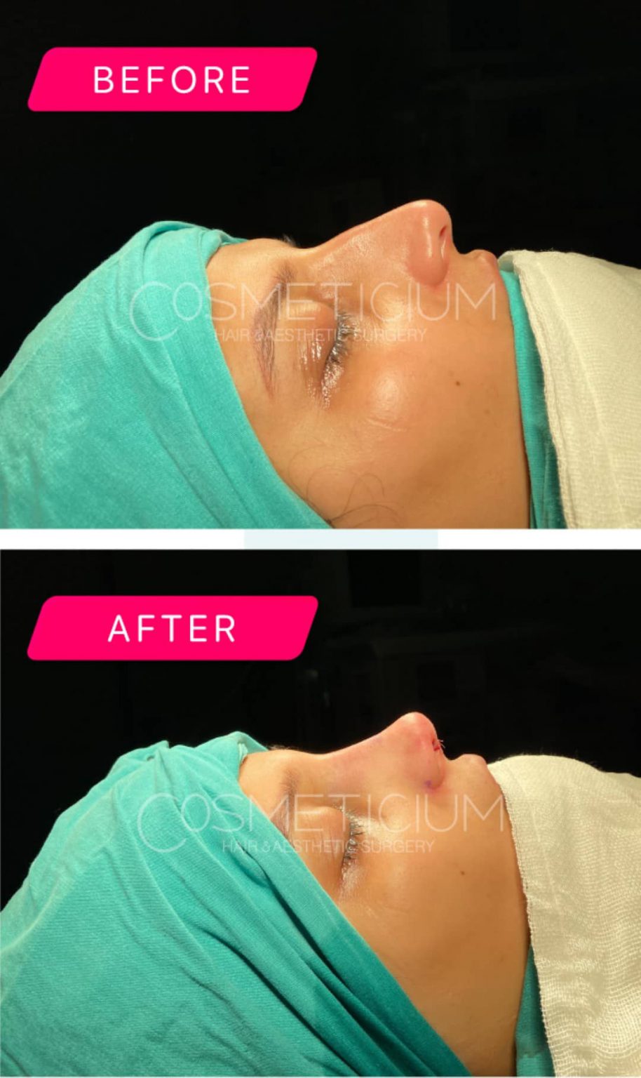 Nose Job Before and After Cosmeticium
