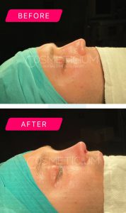 nose-job-turkey-before-after-3