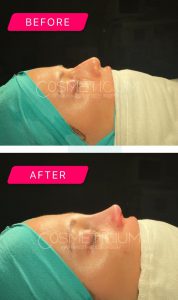 nose-job-turkey-before-after-5
