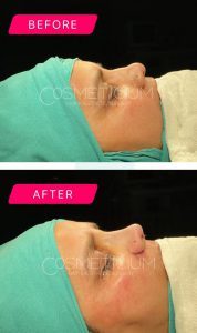 nose-job-turkey-before-after-7