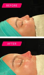 nose-job-turkey-before-after-6