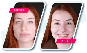 nose job turkey before after-min