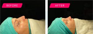 nose job turkey before after photos-04