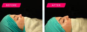 nose job turkey before after photos-05