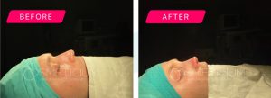 nose job turkey before after photos-06