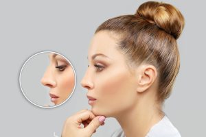 rhinoplasty