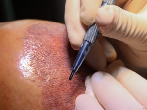 Hair Transplant