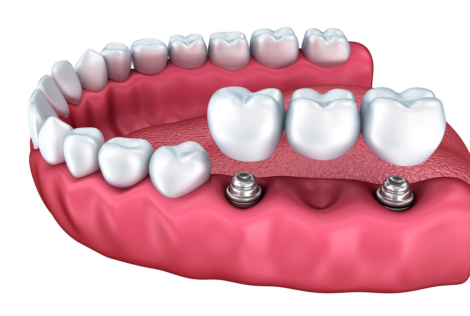 Key Differences Between Composit Bonding and Dental Bridges