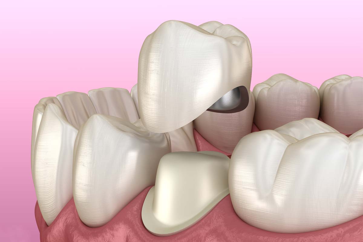 Dental Crowns