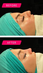 nose-job-turkey-before-after