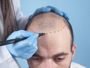Hair Transplant