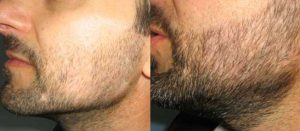 Beard Transplant