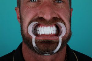 Dental Treatments in Turkey