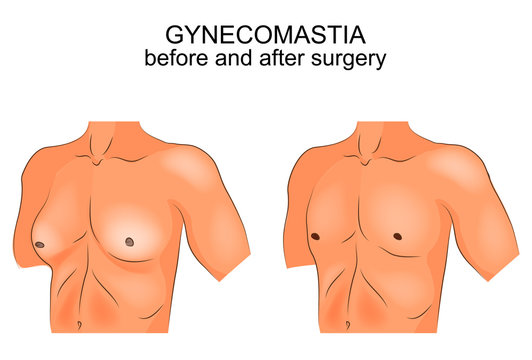 gynecomastia before after