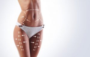 liposuction