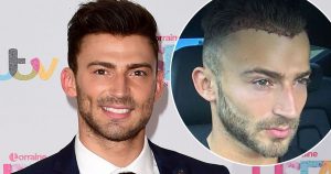 Jake Quickenden's Hair Transplant