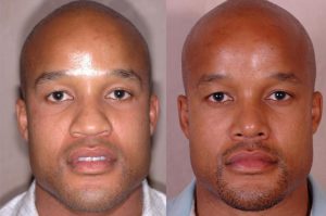 Rhinoplasty