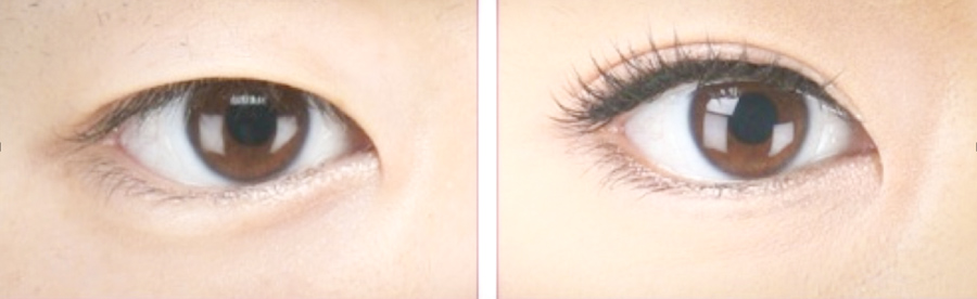 What is Double Eyelid Surgery?