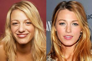 Blake Lively Nose Job