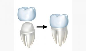 Dental Crowns
