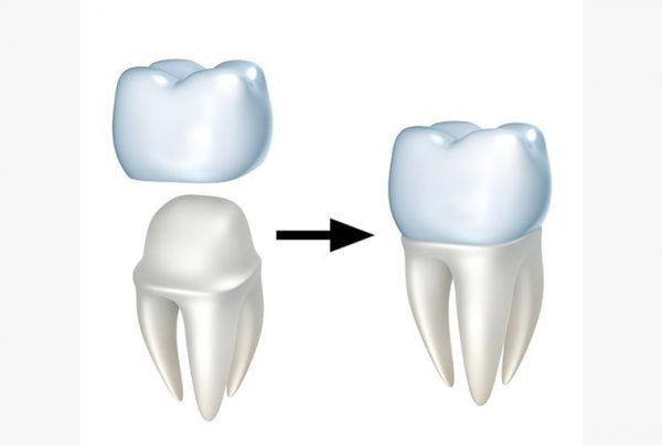 Dental Crowns