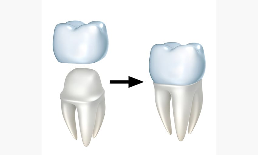 The Crown Conundrum: How Long Does It Take to Adjust to a New Crown?