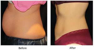 Liposuction Before After
