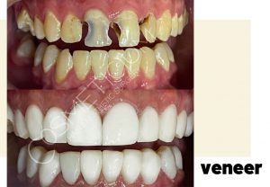 veneers turkey before after result