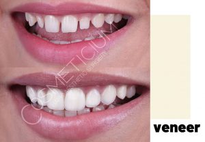 veneers turkey before after result