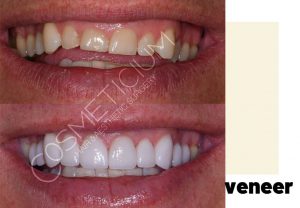 veneers turkey before after result