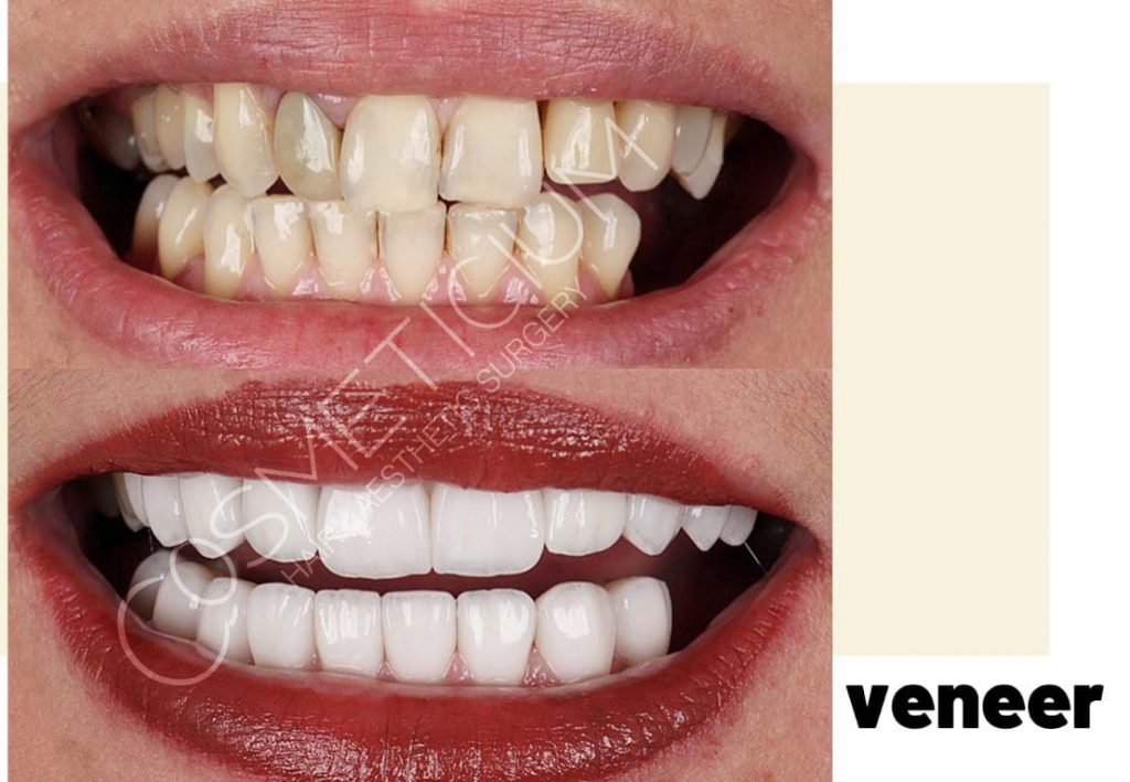 Veneers in Turkey Affordable Cost Smile Makeover Cosmeticium