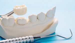 Dental Crowns