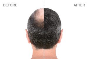Hair Transplant Before-After