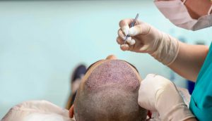 Hair Transplant