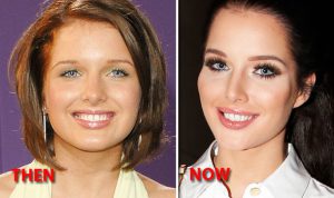 Sofia Richie Nose Job Before After
