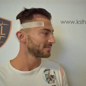 Hair Transplant DHI