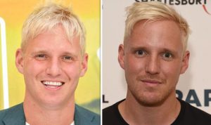 jamie laing hair transplant