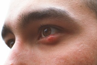 Introduction to Eyelid Sores